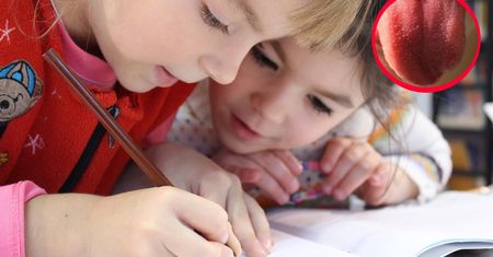Nowy problem ze starą chorobą. Jednym z objawów jest "malinowy język"