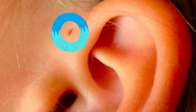 Czy wiesz, co oznacza dziurka przy uchu dziecka? Może być bardzo niebezpieczna