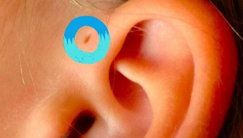 Czy wiesz, co oznacza dziurka przy uchu dziecka? Może być bardzo niebezpieczna