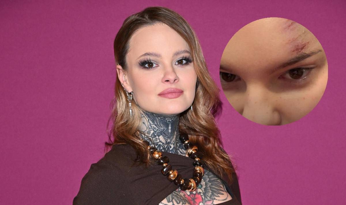 Monika Miller pokazała swoje RANY w sieci. "I jak się wytłumaczyć w pracy?"