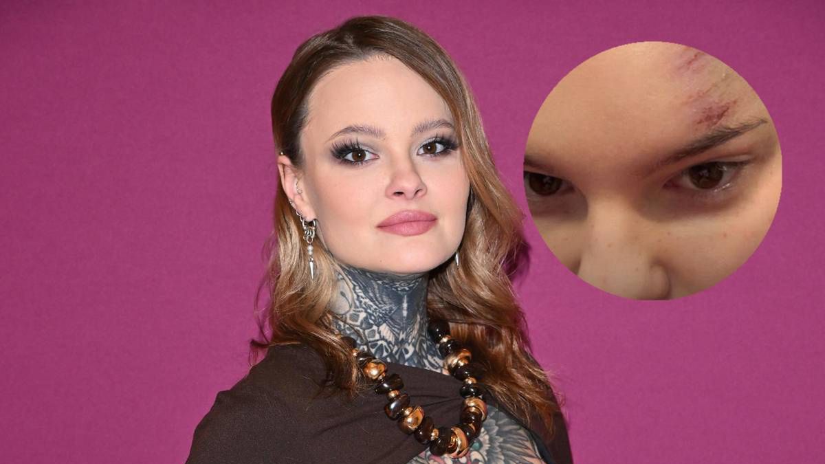 Monika Miller pokazała obrażenia głowy 