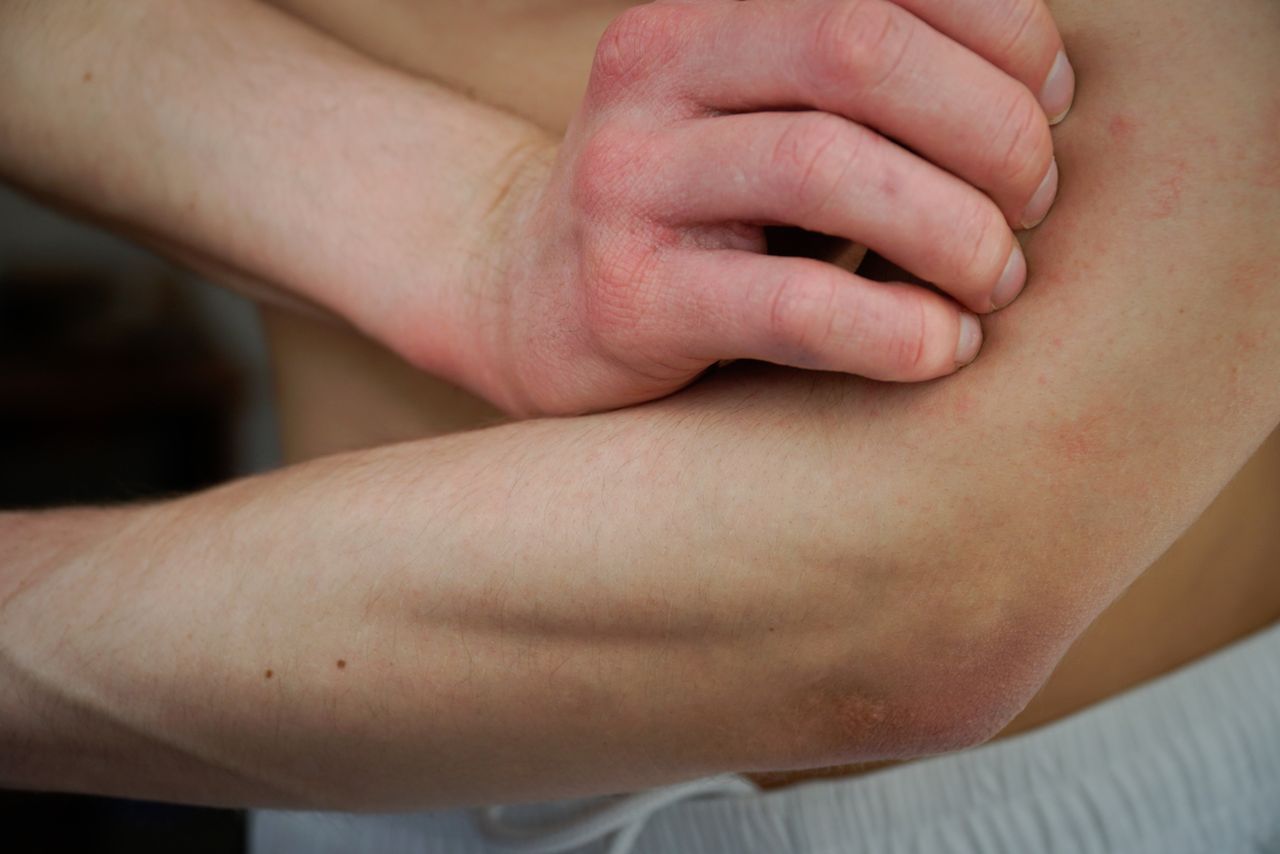 Co na uczulenie? Jak radzić sobie z uczuleniem i objawami alergii