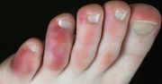 Palce covidowe - przyczyny, objawy, diagnostyka, leczenie