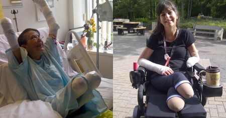 Po ugryzieniu psa amputowano jej nogi i rękę. Miała sepsę