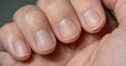 Masz takie linie na paznokciu? Internista mówi, czego to objaw
