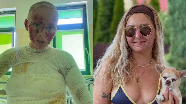 Maja Kuczyńska płonęła żywcem. Tak wygląda w bikini