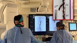 Z nogi pacjenta usunęli zakrzep długości 30 cm. Przełomowa operacja w Przemyślu