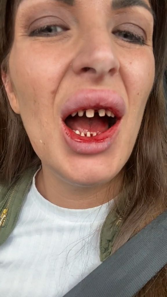 Tiktokerka Amanda Turner zafundowała sobie "tureckie zęby"