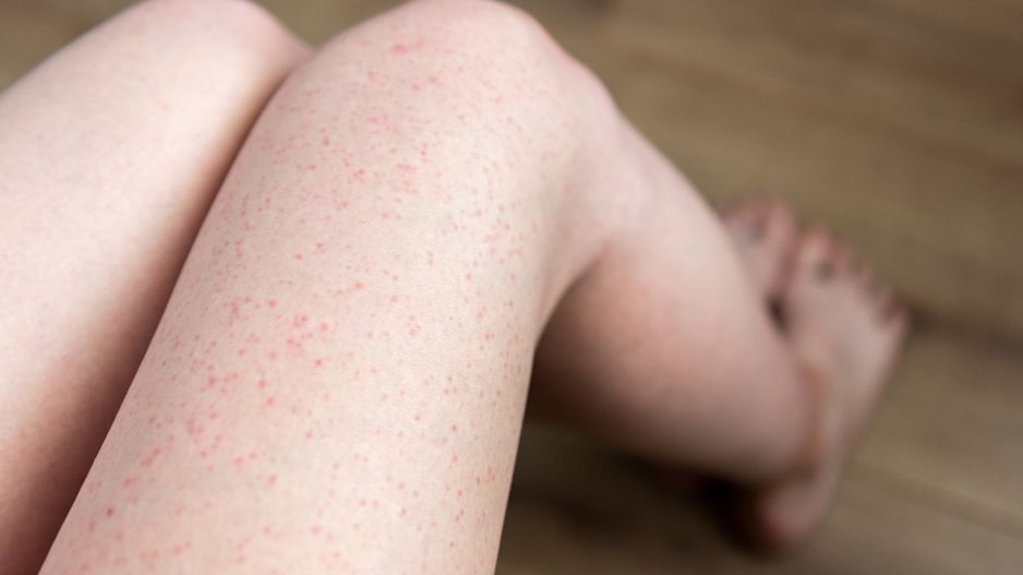 Jak sprawić, by czerwone krostki się nie pojawiały?
