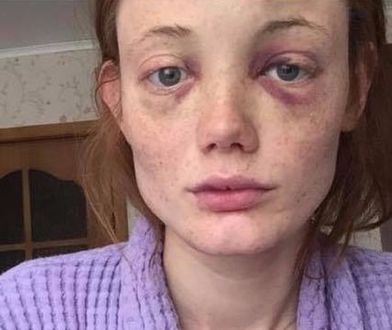 Kira Dice  padła ofiarą przemocy domowej. Opublikowała dramatyczne zdjęcia