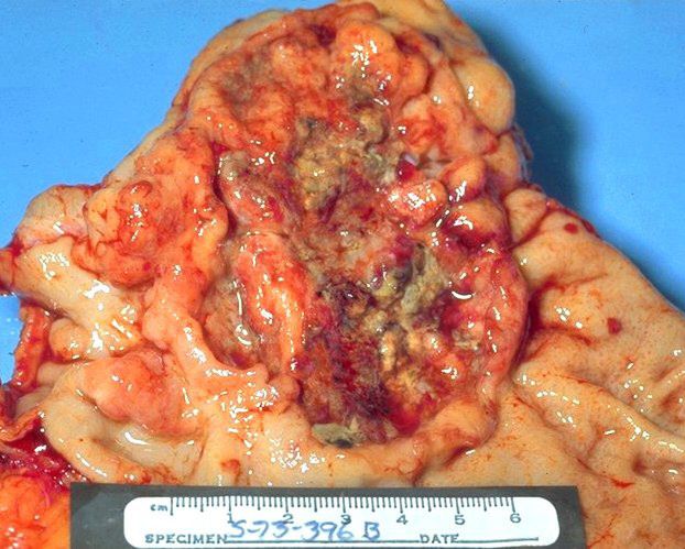 Zdjęcie gruczolaka żołądka 