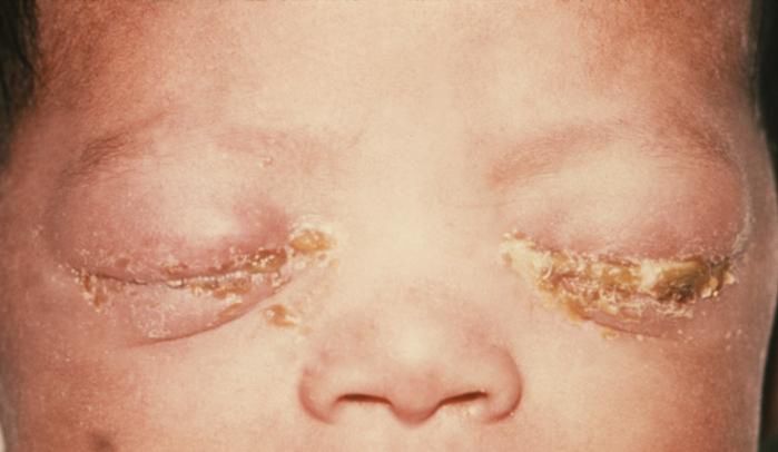 Zmiany w okolicach oczu noworodka wywołane przez rzeżączkę  