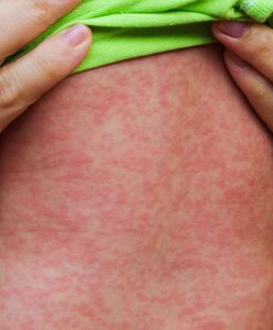 Podejrzenie odry u 6-latka. Dziecko było wcześniej szczepione