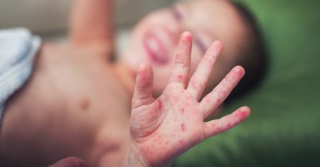 WHO ostrzega przed odrą. 4-krotny wzrost zachorowań w Europie