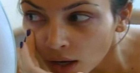 Kardashian nie może żyć bez botoksu