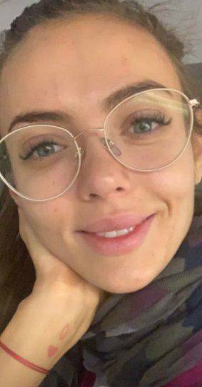 Marcela Leszczak pokazała blizny po trądziku