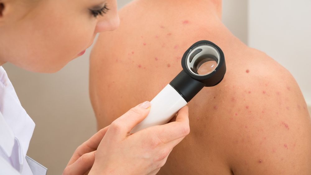 Sposoby na pryszcze na plecach