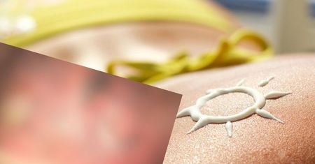 Doznała poważnych oparzeń słonecznych. Pokazała zdjęcie ku przestrodze