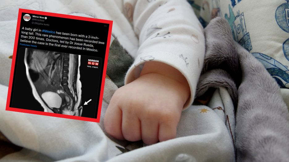W Meksyku urodziła się dziewczynka z ogonem