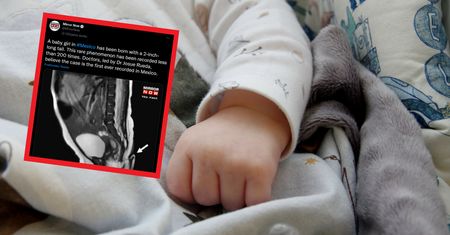 Szok na porodówce, noworodek urodził się z ogonem