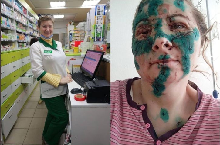 Farmaceutka z Charkowa pokazała swoje zdjęcie. Tak wygląda jej twarz po rosyjskim nalocie bombowym