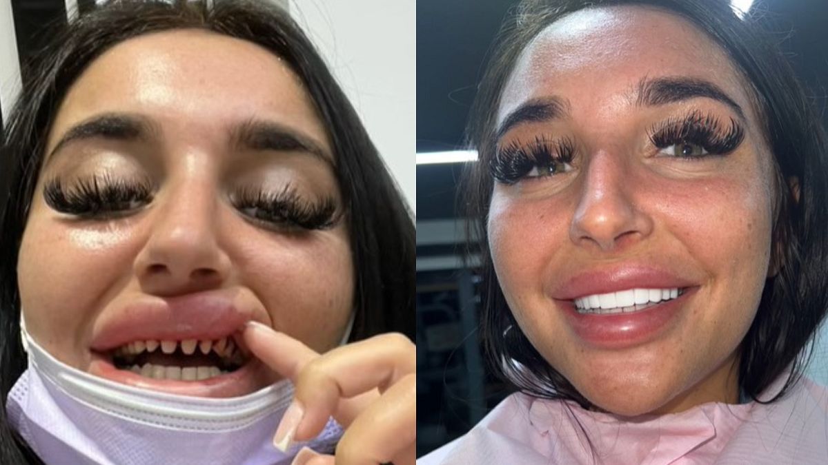 Zrobiła sobie "tureckie zęby". Zebrała ponad 17 tysięcy wyświetleń 