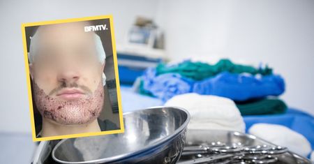 Pojechał do Turcji zrobić przeszczep brody. 24-latek z Francji nie żyje