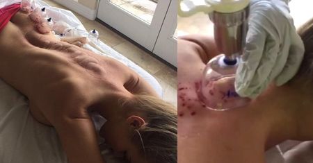 Joanna Krupa stawia sobie bańki na Instagramie (ZDJĘCIA)