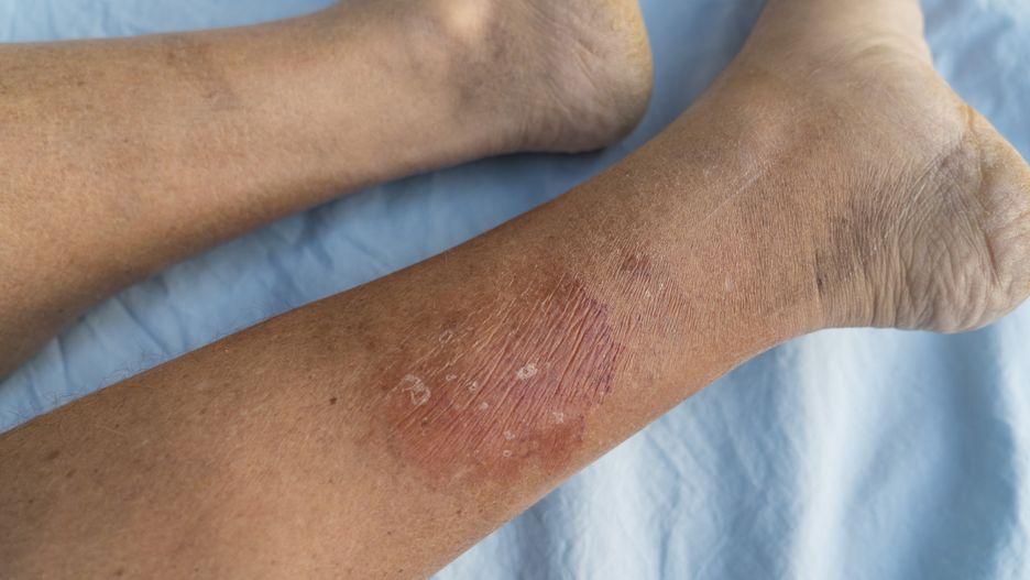 Sepsa wśród dzieci. Rocznie dotyka nawet 20 milionów dzieci do piątego roku życia