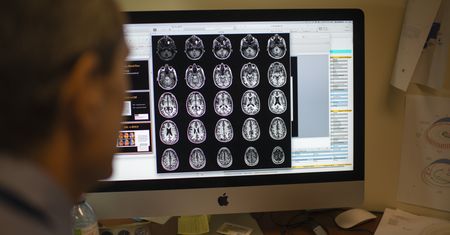 Tłuszcz w mózgu może napędzać Alzheimera? Najnowsze wyniki badań