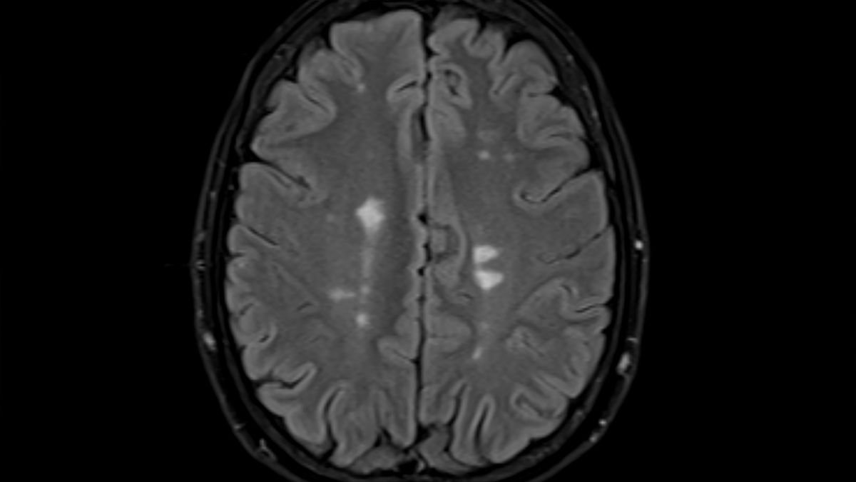 Stwardnienie rozsiane powoduje zmiany w mózgu prowadzące najczęściej do trwałej niepełnosprawności