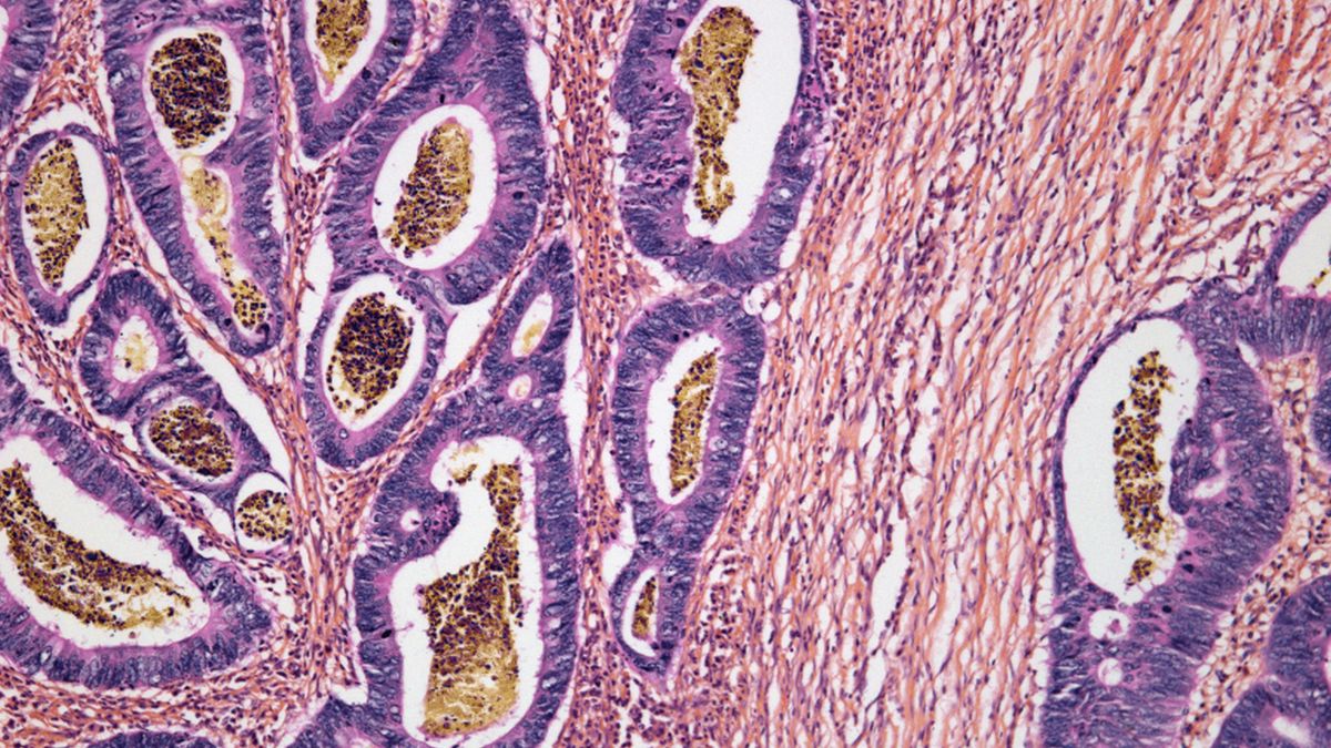 Naukowcy znaleźli korelację między rakiem jelita grubego a prowadzeniem niezdrowego trybu życia