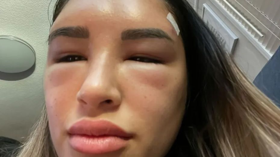 Lifting brwi miał poprawić urodę młodej dziewczyny