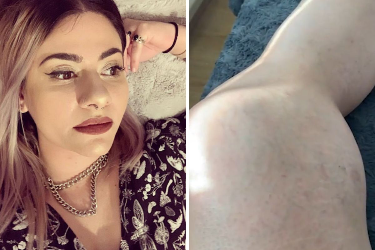 Guz na kolanie Joanny przez lata rósł, osiągając niepokojące rozmiary