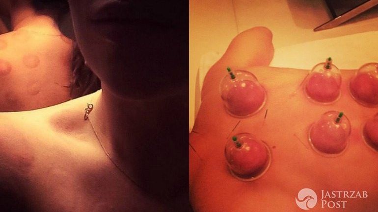 Madonna postawiła sobie bańki