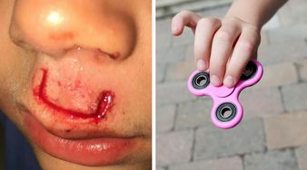 Fidget Spinner znowu zbiera żniwo. Tym razem pokaleczył dziecku twarz