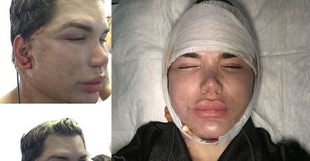 Żywy Ken o liftingu: "Nie mogę nic jeść, bo szwy na twarzy EKSPLODUJĄ"
