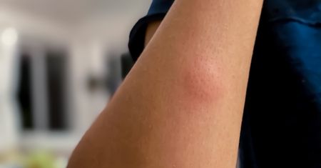 Zauważyłeś to na skórze? Uważaj, możesz być uczulony na komary