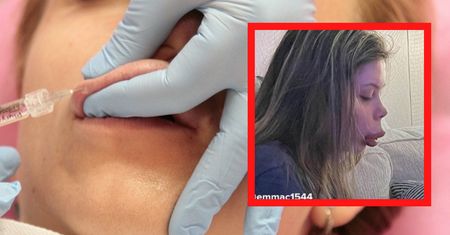 Powiększyła usta za pół ceny. Efekt nie był taki, jak sobie wymarzyła