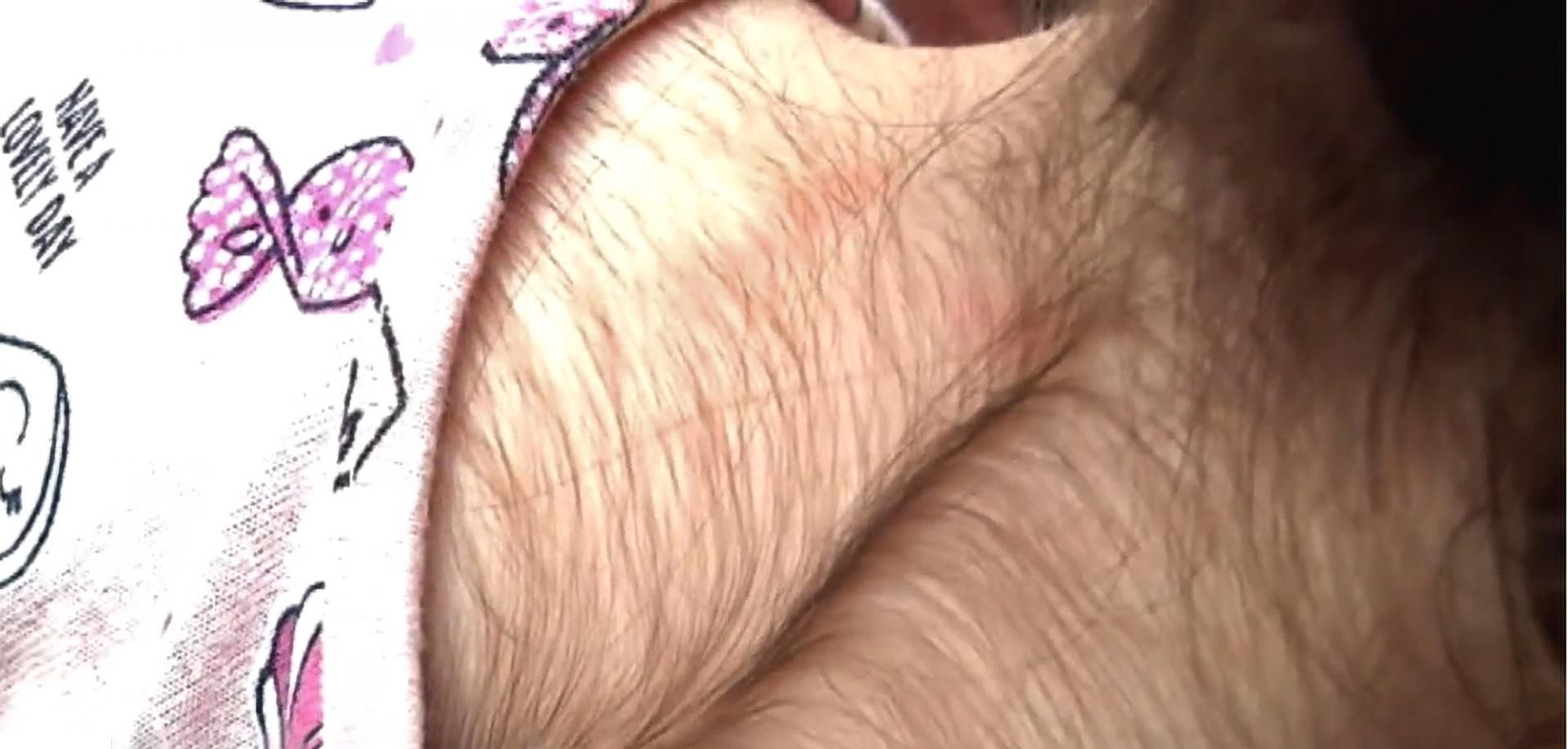 Efekty stosowania minoksydylu u dzieci 