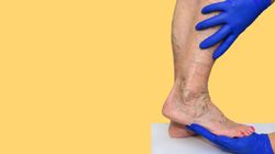 Pajączki na nogach - przyczyny, objawy i leczenie. Domowe sposoby na pękające naczynka