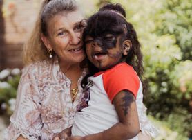 Symmie z Australii cierpi na syndrom SCALP. Dziewczynka ma liczne deformacje, padaczkę i autyzm