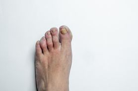 Żółte paznokcie u nóg - grzybica stóp, pałeczka ropy błękitnej