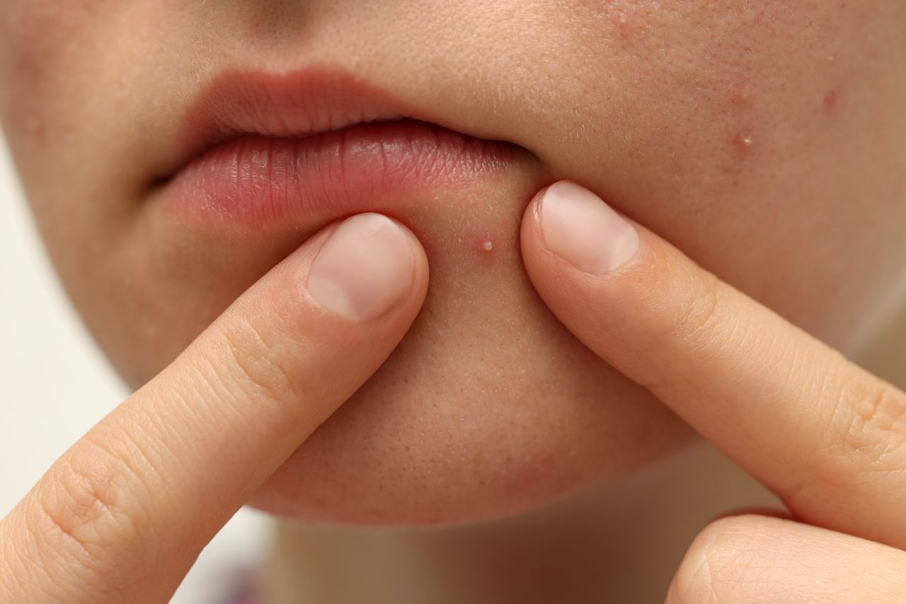 Why is it not worth squeezing pimples?