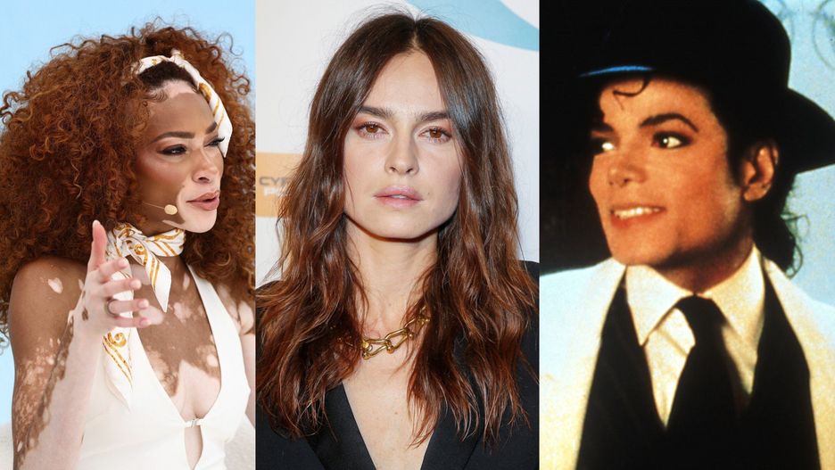 Winnie Harlow, Kasia Smutniak i Michael Jackson to jedne z najbardziej znanych osób, które zachorowały na bielactwo.