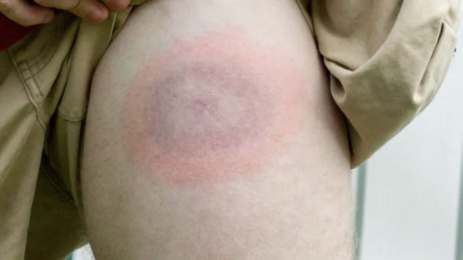 Gdy się pojawia, zabierz dziecko do lekarza. Charakterystyczny objaw po ukąszeniu kleszcza