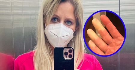 Objaw Raynauda najczęściej pojawia się na dłoniach. Może zwiastować raka