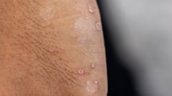 Naukowcy powiązali toczeń z wirusem. Jego nosicielem jest prawie każdy 