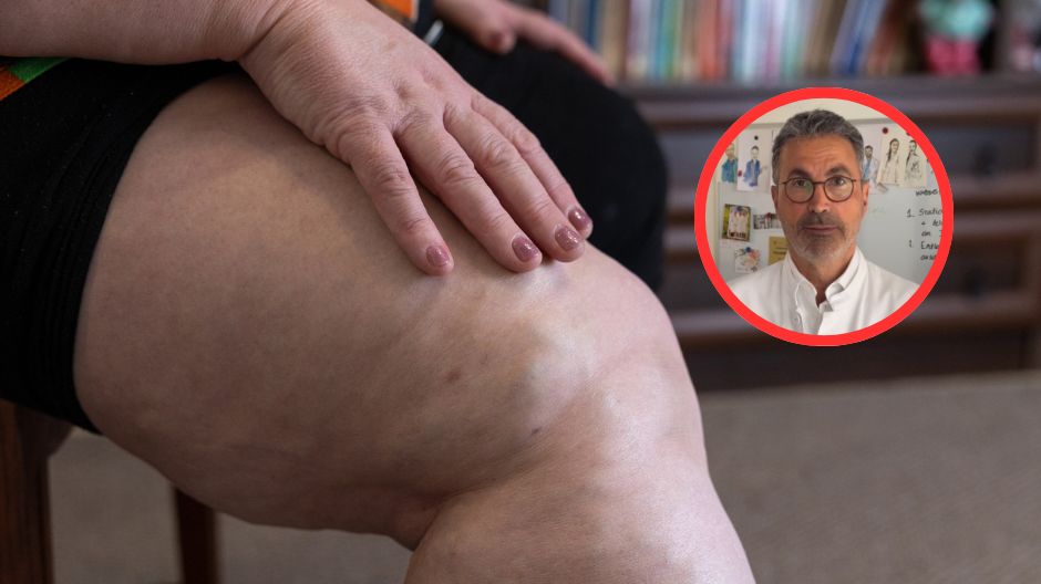 Lipodemia to choroba, którą latami ignorowano. Chirurg alarmuje o skali cierpienia kobiet