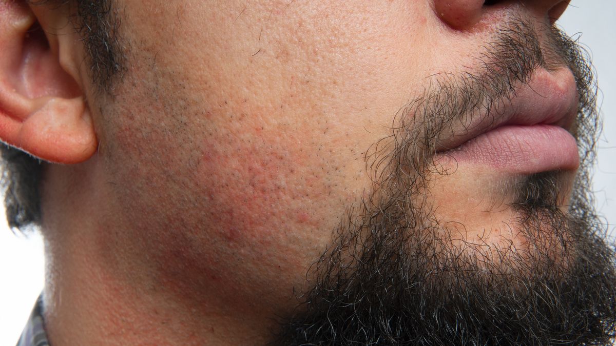 Close-up portrait of a Irritation after shaving on the neck of a manClose-up portrait of a Irritation after shaving on the neck of a man. Horizontal composition. Studio shot.Alihan Usullu